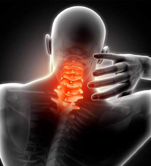 Cervical Spondylosis