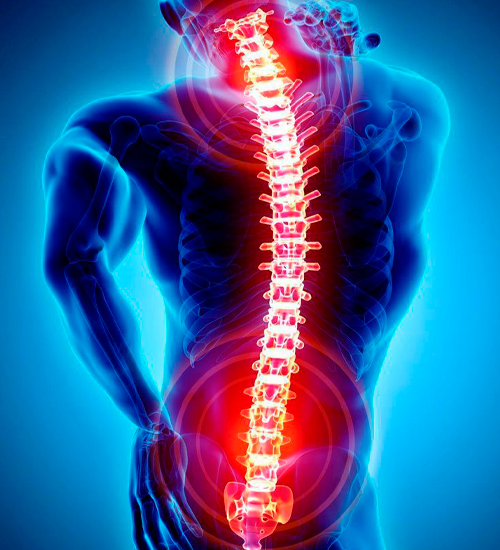 Intervertebral Disc Prolapse