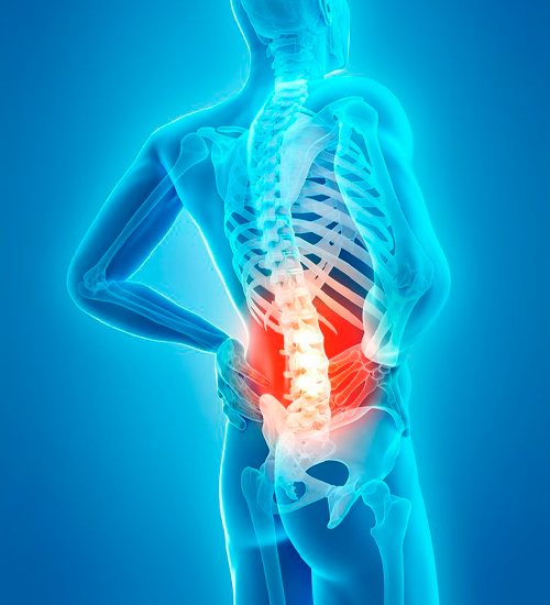 Lumbar Spondylosis